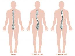 Scoliosis1