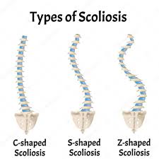 Scoliosis2