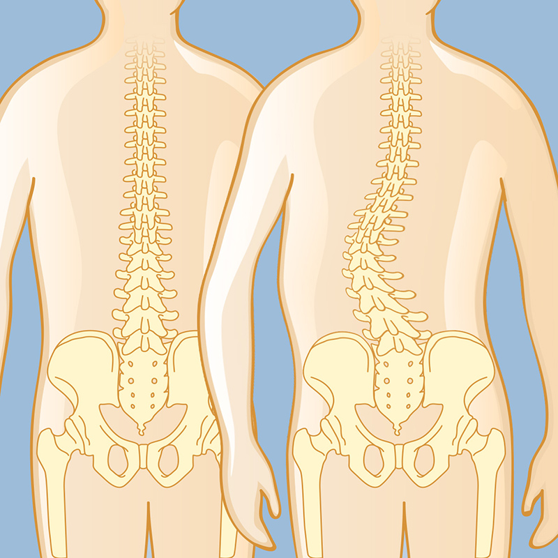 Scoliosis Intro